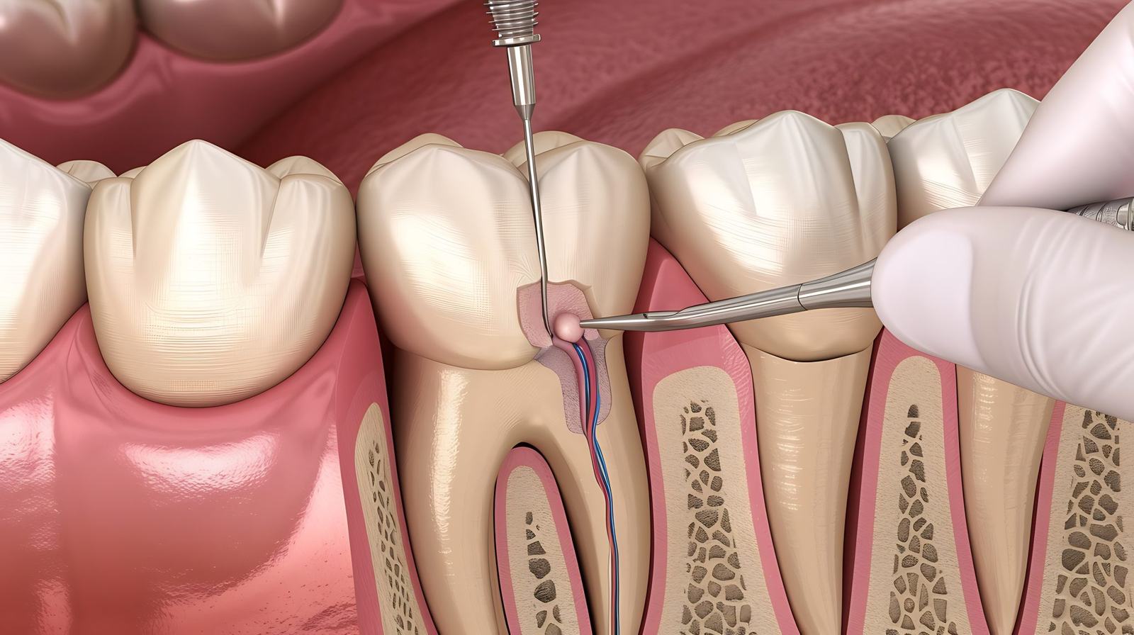 what-is-root-canal-therapy